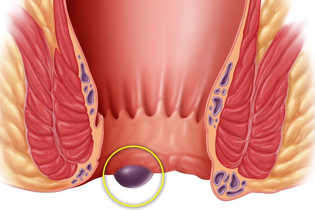 hemorrhoid
